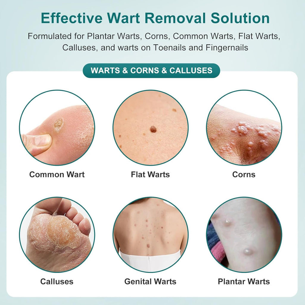 Tag Removal Wart Remover Fast Acting Gel – Maximum Strength Freeze Off Ointmen Fast Acting Natural Common Wart Removal for Plantar,Genital,H (Green-b, S)